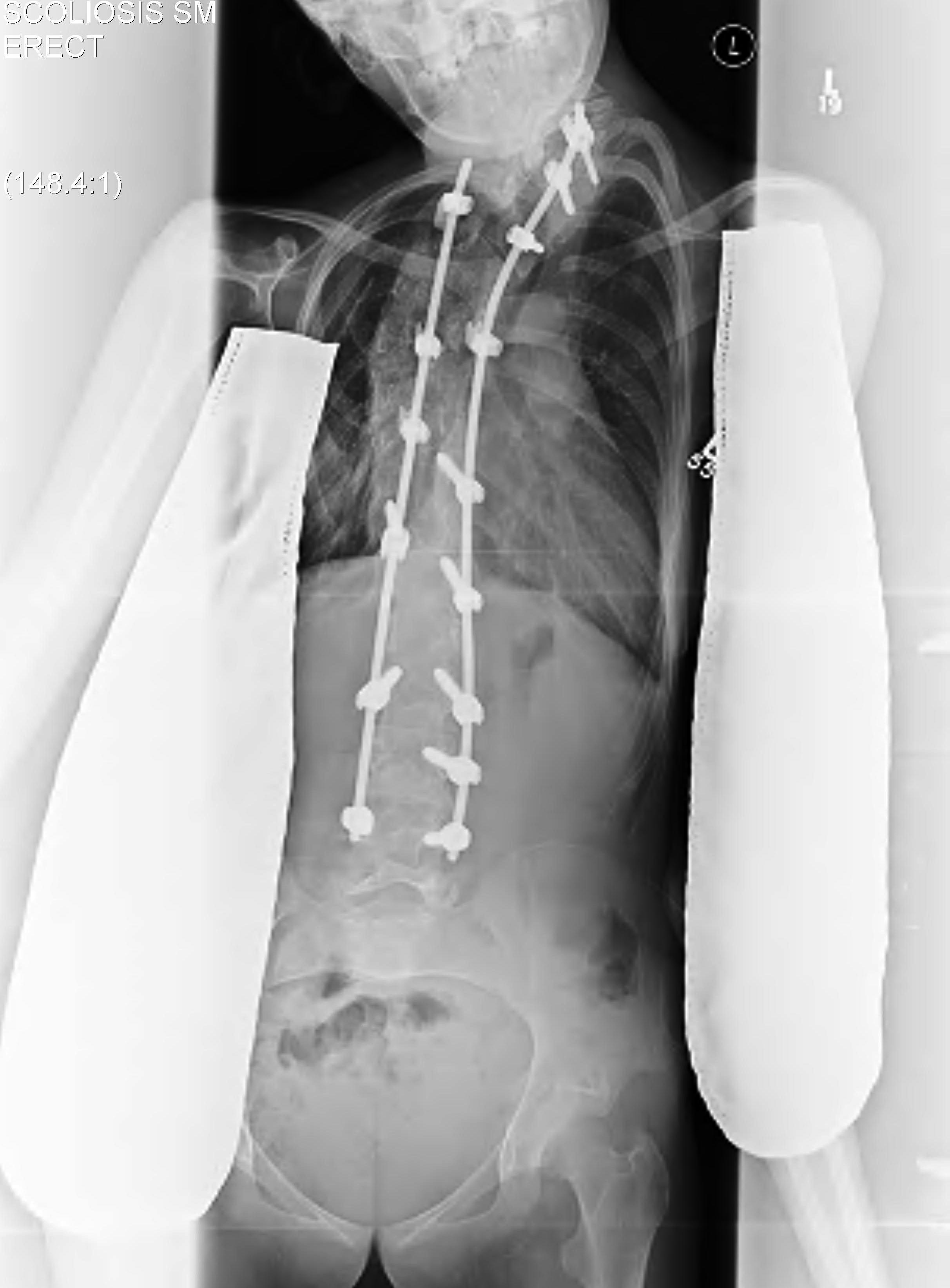 Neuromuscular Scoliosis Posterior Fusion
